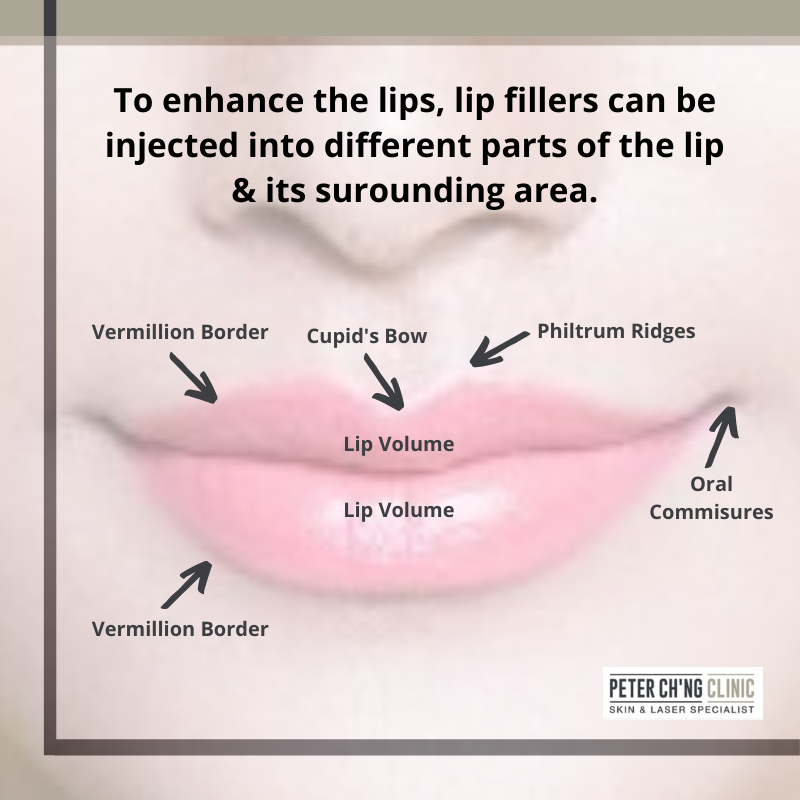 How To Inject Lips With Filler Lipstutorial Org